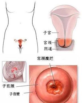 宫颈糜烂最新手术治疗方法与神秘妇科诊所的隐秘故事